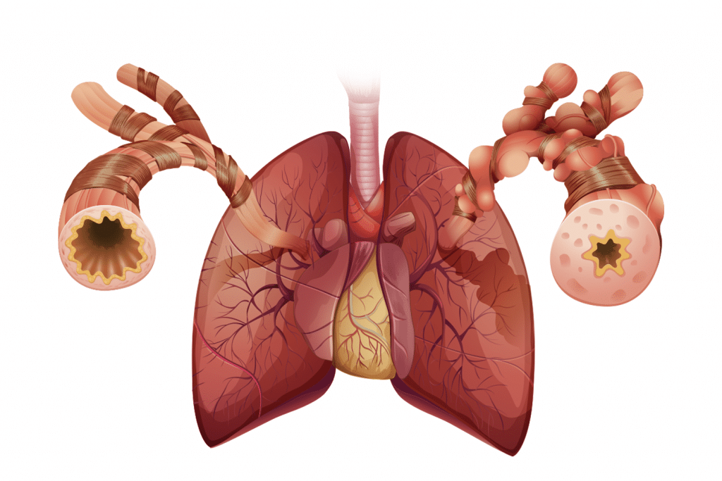 Lignosus United States - Blog Article - 8 Soothing Natural Remedies For Bronchitis So You Can Image 1