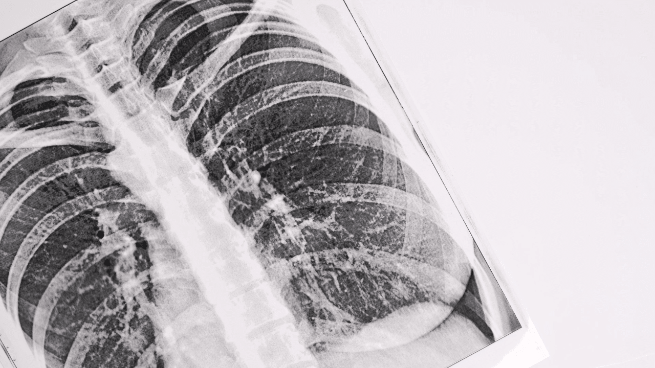 Bronchitis Exposed! Navigate Symptoms, Surprising Causes, and Revolutionary Treatments Today!