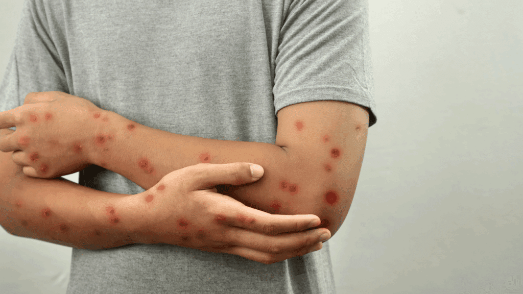 Understanding Mpox: What It Is and How It Spreads
